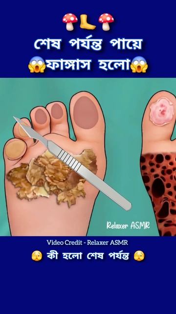 পায়ে যখন ফাঙ্গাস হয় তখন কিভাবে ট্রিটমেন্ট হয় #3danimation