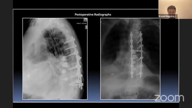 Evolution of Spine in Inflammatory Arthritis – John R. Dimar, II, MD смотреть онлайн