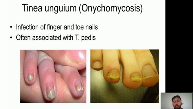 Medical Mycology Tenth lecture (Cutaneous Mycoses) смотреть онлайн