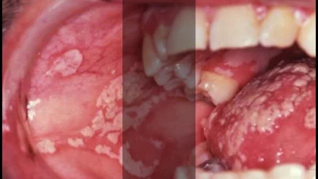 Candida albicans смотреть онлайн