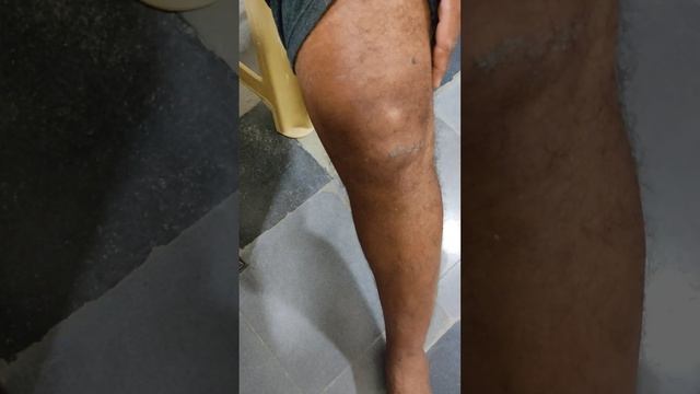 Knee Pain With Swelling....Dr Sai Chandra MBBS DNB (Ortho) смотреть онлайн