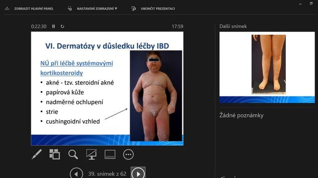 Seminář: Kožní Problémy Pacientů S IBD, MUDr. Karolína Svobodová