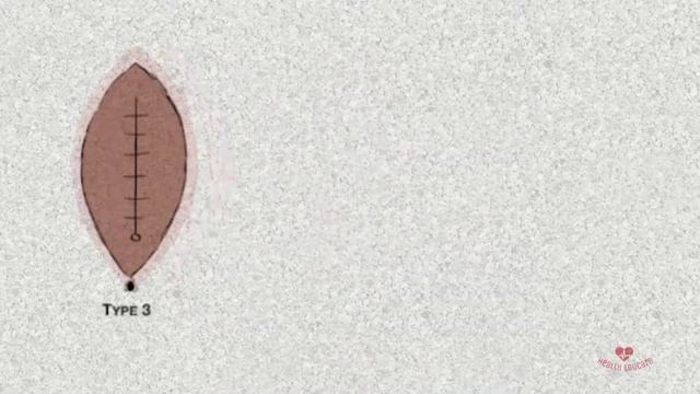 FEMALE CIRCUMCISION: 4 types of Female Genital Mutilation (FGM) смотреть онлайн