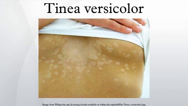 Tinea Versicolor
