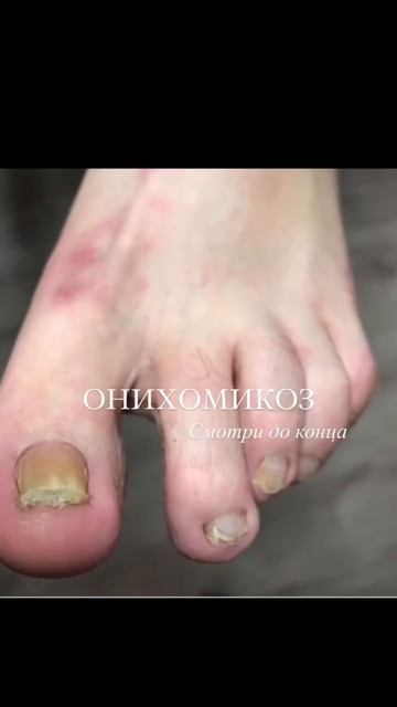 Грибок ногтей #грибокногтей #маникюр #подолог #nails #здоровье