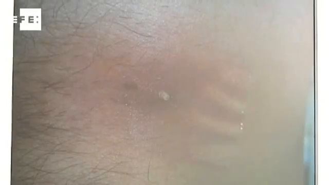 Un hospital madrileño halla el primer caso en el mundo de miasis en humanos смотреть онлайн