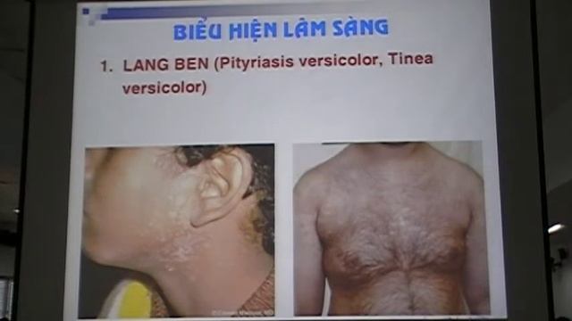 BỆNH DO MALASSEZIA SPP
