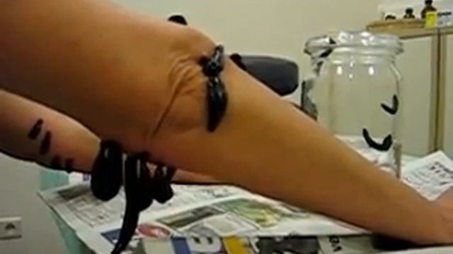 ameliyat,hacamat,denizli sülük,iyileşmek,damar tıkanıklığı,пиявки -거머리leeches therapy -水蛭-19 смотреть онлайн