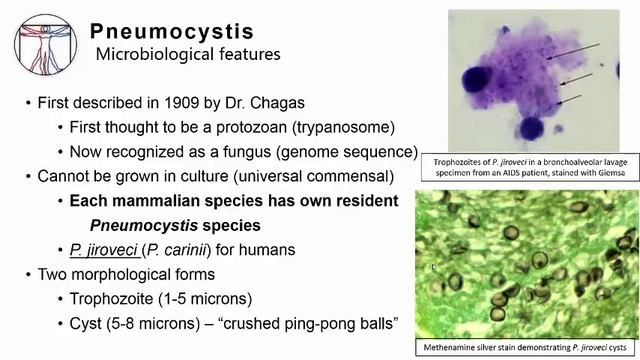 5. Pneumonia Pneumocystis