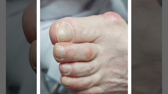 грибок ногтей, вылечили! смотреть онлайн