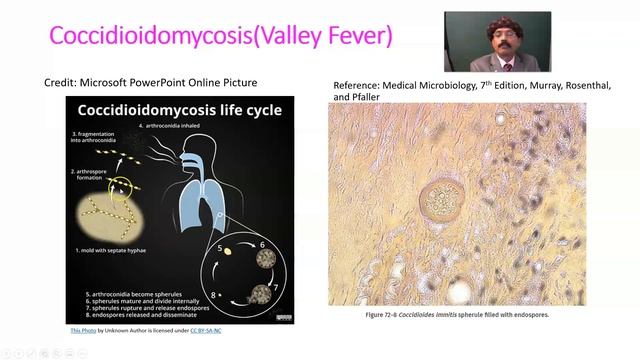 Coccidioidomycosis (Valley Fever)