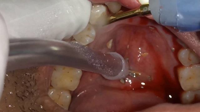 20 Years of Dental Calculus Removed with Ultrasonic Scaler - Tartar And Calculus Removal Part 1 смотреть онлайн