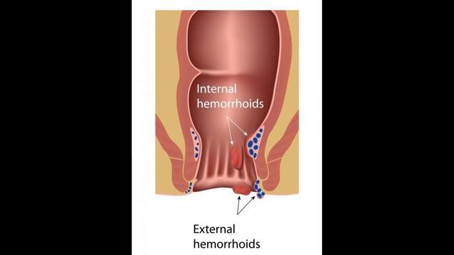How do I Use Witch Hazel for Hemorrhoids смотреть онлайн
