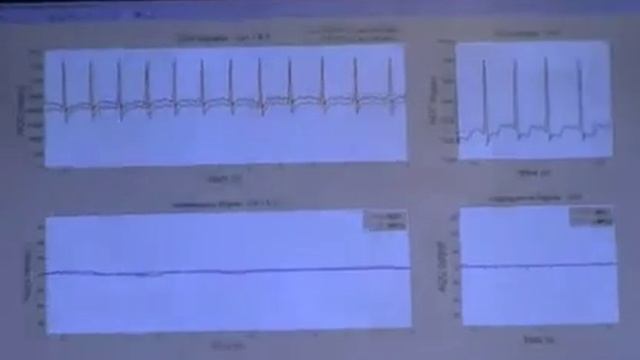 ISSCC 2012: 6.5 A 160μA Biopotential Acquisition ASIC with Fully Integrated IA and Motion-... смотреть онлайн