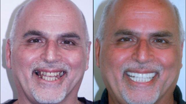 Algodones Dentist | phone today for a quote 619-818-1303 смотреть онлайн