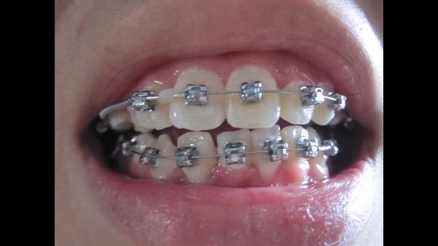 Braces - Before and After (Time Lapse) смотреть онлайн