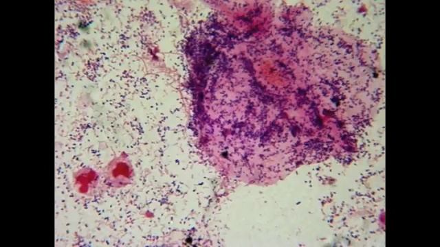 Bacterial Vaginosis(vaginitis) ; التهاب المهبل