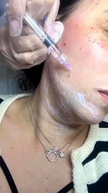 Как проходит процедура биоревитализации💁🏼♀️ #лазернаяэпиляция #депиляция #электроэпиляция #космет смотреть онлайн