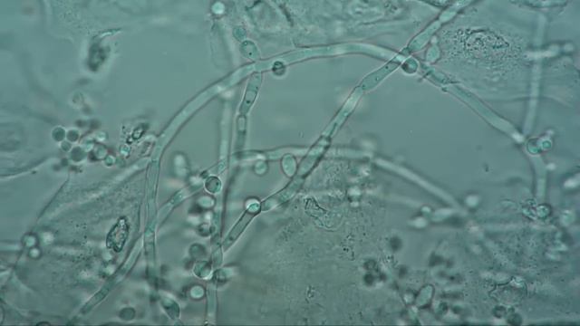 Gynaecology. Candidiasis. Candida Albicans.