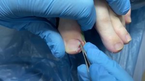 ГЛУБОКО ВРОС НОГОТЬ! ЧТО ДЕЛАТЬ #аленалаврентьева #подолог #подология #обучениеподологии #вросногот