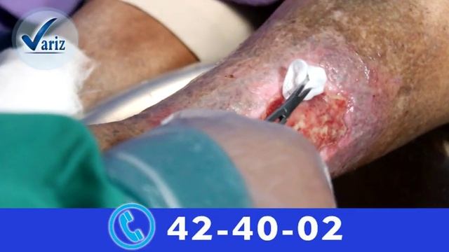 VARICES Y ULCERAS VARICOSAS