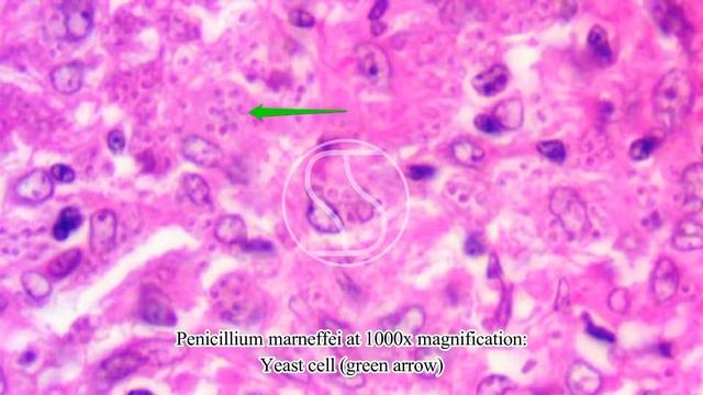 Penicillium marneffei under the microscope with Haematoxylin and Eosin (H&E) stain смотреть онлайн