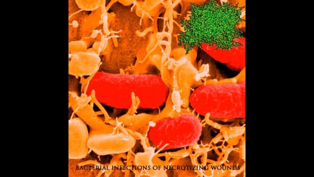 DxTxS - Bacterial Infections Of Necrotizing Wounds | 2013