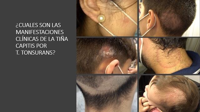 TIÑA CAPITIS PELUQUERÍAS DR GALVAÑ V CONGRESO DERMACHAT