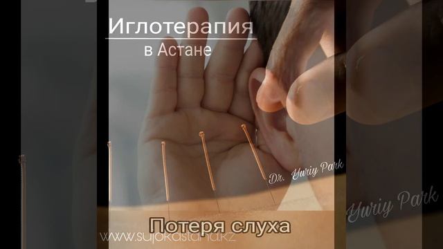 Иглотерапия в Астане смотреть онлайн