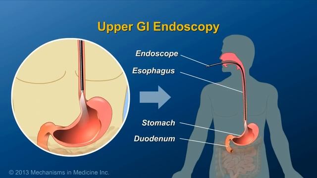Diagnosing IBD смотреть онлайн
