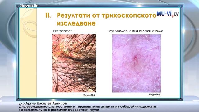 Диференциално-диагностични и терапевтични аспекти на себорейния дерматит на капилициума смотреть онлайн