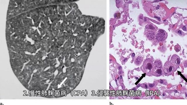 sydowii 麴菌：一種引起人類多種疾病的病原真菌，據信與天鵝座珊瑚（Gorgonia spp）的死亡有關 смотреть онлайн