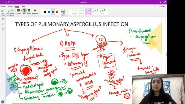 Radiology Signs | High Yield image review in radiology | Aspergillosis | Dr. Zainab Vora смотреть онлайн