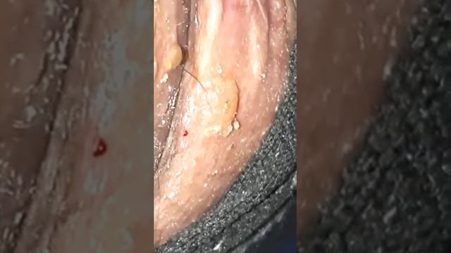 Tungiasis Severa-hyperinfection смотреть онлайн