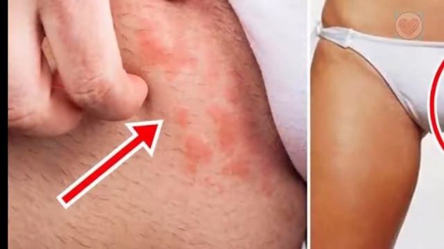 Candidíase Cutânea, Candidíase na pele : Causas, Tratamento e prevenção.