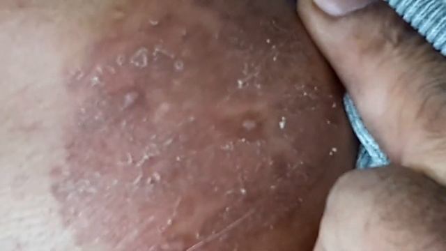 Tinea Corporis. Gentamicin280mg+Kenalog20mg Doxycycline1bd27 Fluconazole1daily12+Ivermectin10mg смотреть онлайн