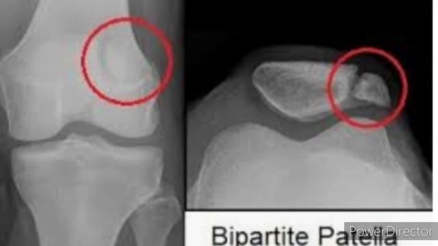 Bipartite patella ! смотреть онлайн