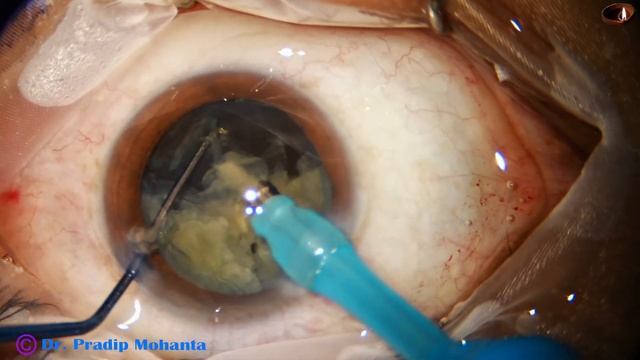 USE OF EPINUCLEUS TO PROTECT POSTERIOR CAPSULE- Let PCR be a past thing in your surgeries- P Mohant смотреть онлайн
