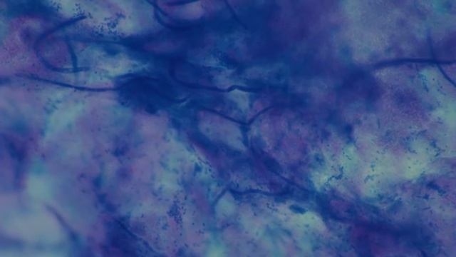 Dermatologia. Balanopostitis. Candida albicans. смотреть онлайн