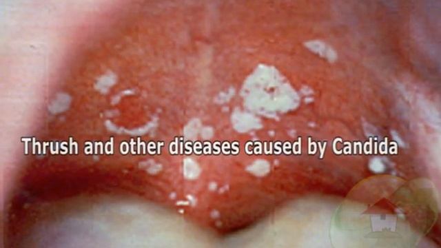 Candida albicans смотреть онлайн