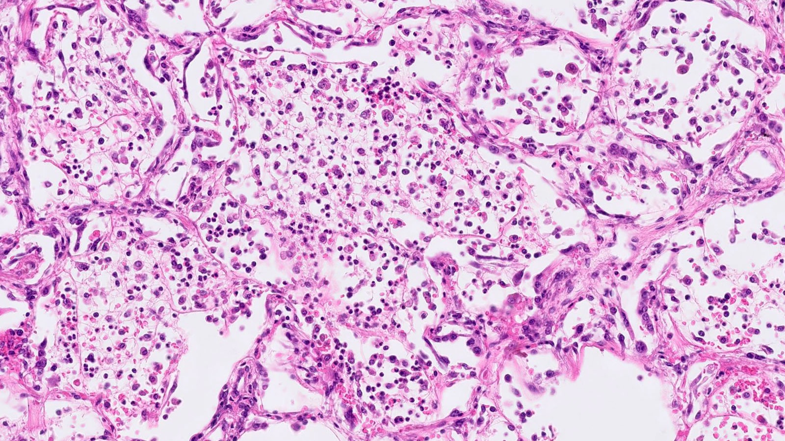 Острые заболевания органов дыхания смотреть онлайн