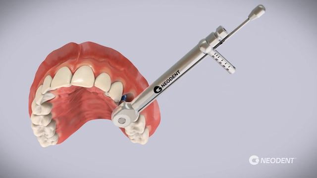 Neodent - Implant Titamax Smart Cortical