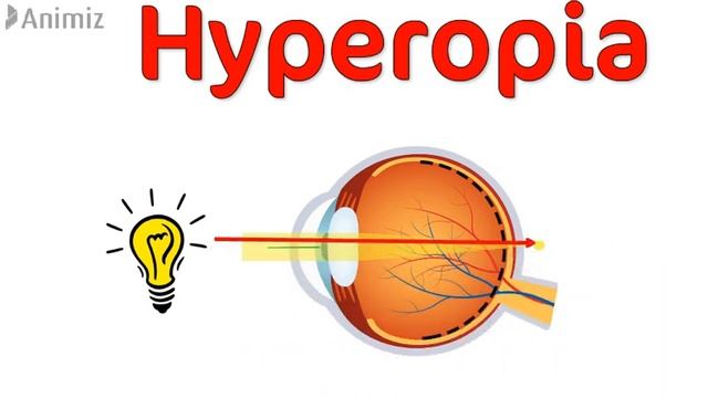 COMMON EYE DEFECTS( MYOPIA, HYPEROPIA, ASTIGMATISM, PRESBYOPIA ) смотреть онлайн