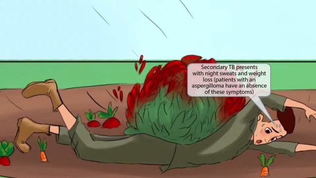 Aspergillus Fumigatus For The USMLE Step 1