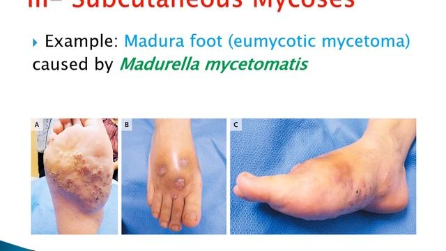 32) Fungal diseases смотреть онлайн