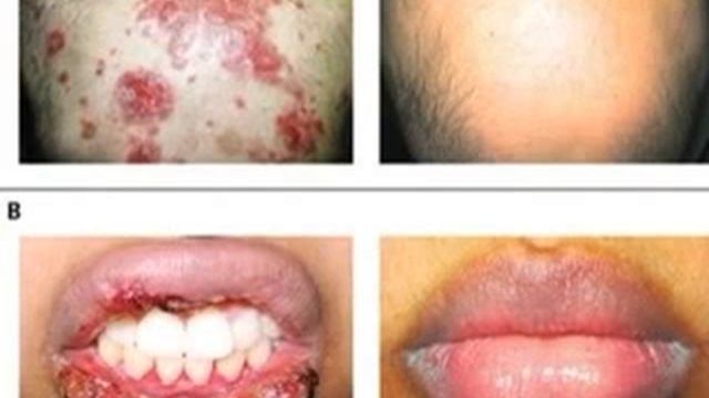 pemphigus vulgaris смотреть онлайн