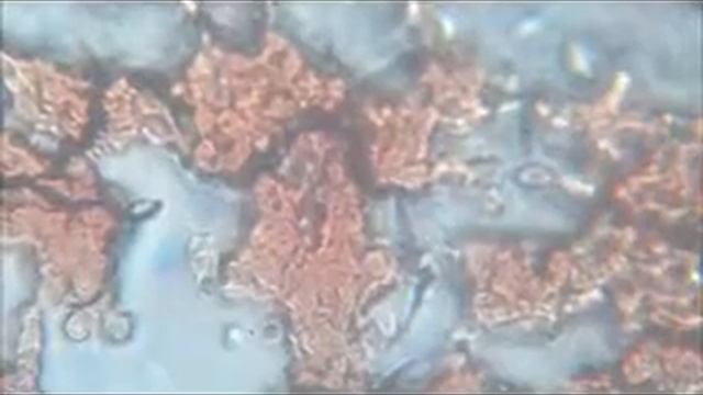 Sangue letteralmente infestato da Cryptococcus Neoformans in paziente demente смотреть онлайн