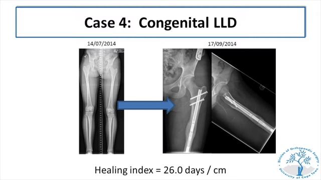 Limb salvage - what is new? - Session 1 - 14h50 - Maritz Laubscher смотреть онлайн