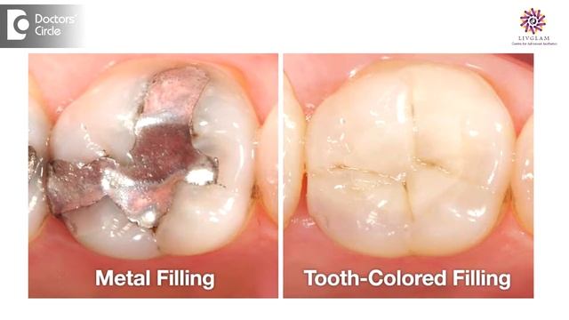 Can mercury leak from amalgam fillings? - Dr. Harish B смотреть онлайн