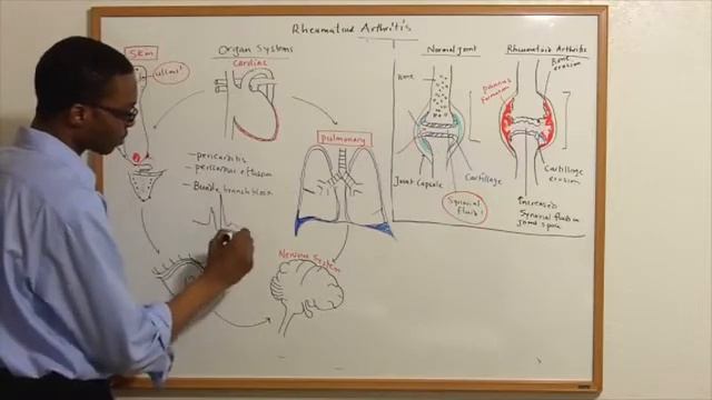 Rheumatoid Arthritis RA смотреть онлайн